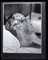 Grand jury exhibit photograph of Darby Day Jr.'s facial acid burns, Los Angeles, 1925