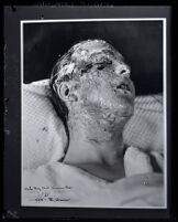 Copy of grand jury exhibit photograph of Darby Day Jr.'s facial acid burns, Los Angeles, 1925