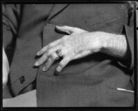 Scar on hand of murder suspect Arthur C. Burch, Los Angeles, 1922