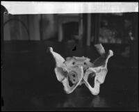 Nicoleño pelvic bone with evidence of an arrow injury, recovered during Arthur Sanger's expedition to San Nicolas Island, sits on a table, Los Angeles, 1928